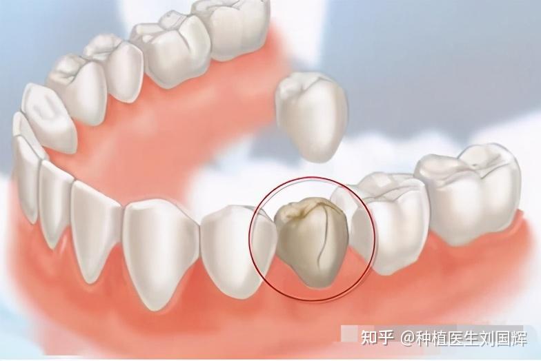 好傢伙根管治療沒做牙冠結果牙齒直接劈成兩半