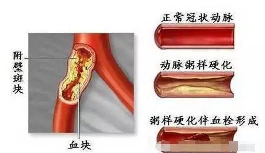 血管堵塞的人身体会有这4个表现赶紧看看自己有没有中招