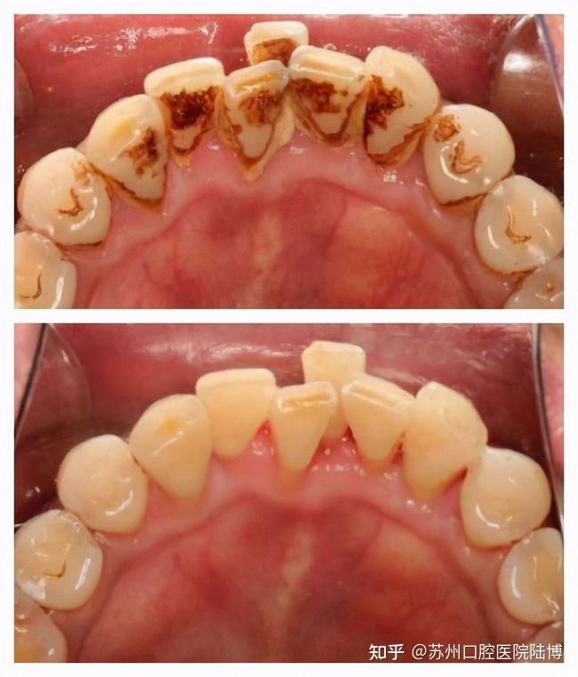 每年堅持洗牙,10年後你的牙齒會有什麼變化? - 知乎