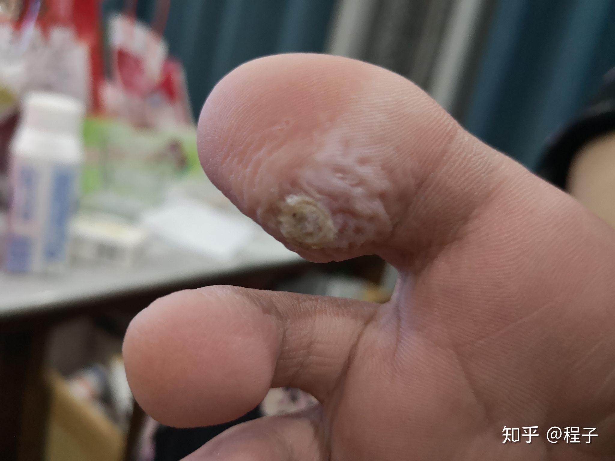 记录我的跖疣治疗过程