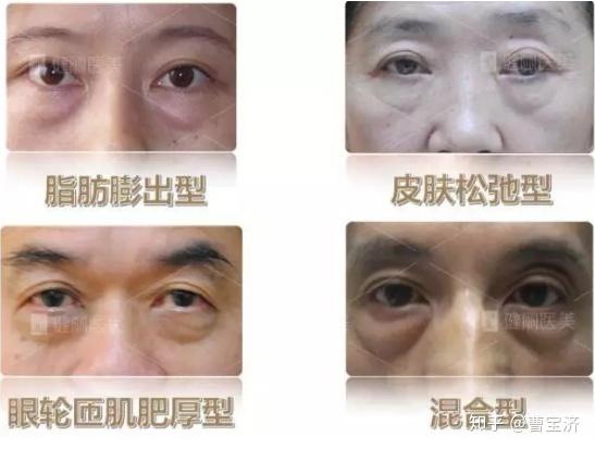 怎样快速去眼袋最有效的方法 v2-276e71a1b5914fbb831eb3c77336d74d_r.jpg