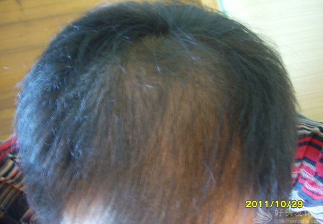 8年遗传性脱发治疗一年这效果能打几分