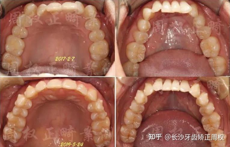 x線片檢查:牙周狀況一般,上下前牙牙槽骨,由於上下前牙創傷,已經有骨