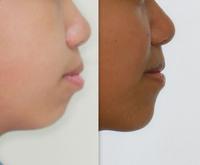 隐适美隐形矫正病例(高角,前突龅牙,拔牙矫正,下巴改形)