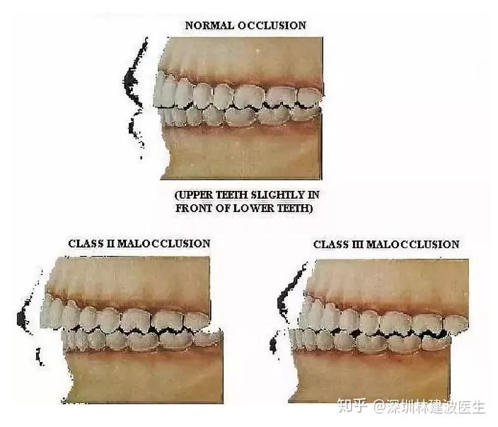 可通过改善嘴型来改善脸型.我们的嘴型和牙弓,咬合联系密切.