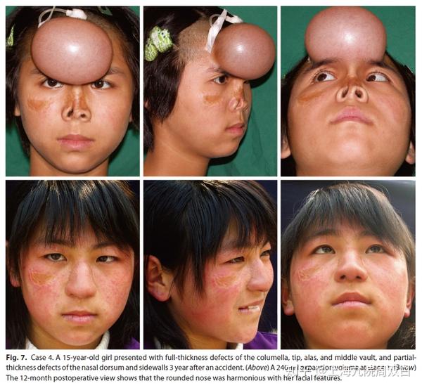 鼻缺损的修复重建