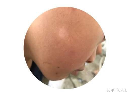 白癜风:白斑明显,皮损呈乳白色,边界有色素加深,白斑表面光滑无鳞屑