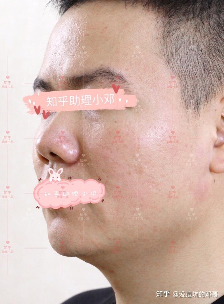 厢车型痘坑冰锥型痘坑的混合类型痘坑痘印炎症做了点阵激光一组后的