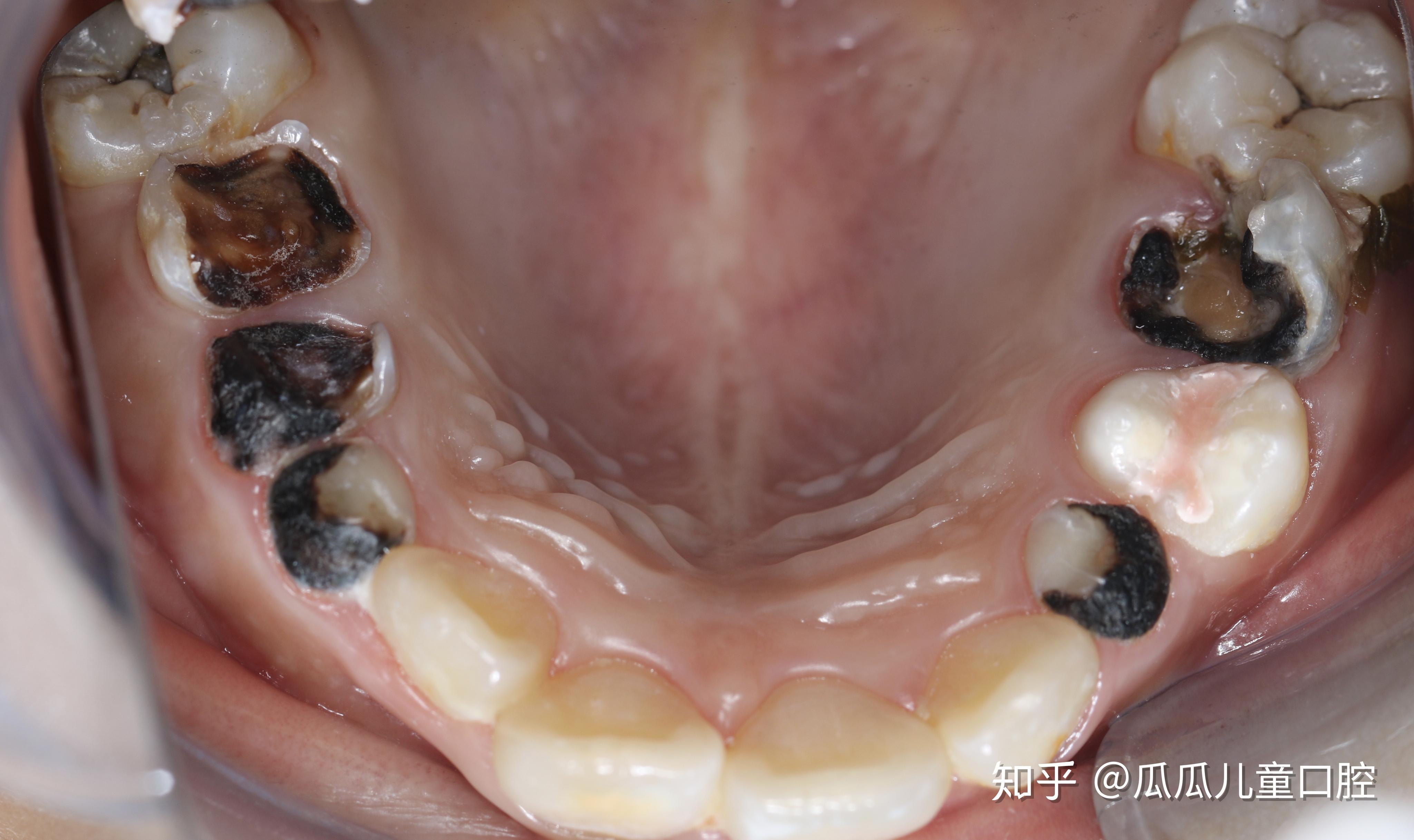 南京德牙联合口腔陈杰：龋齿的成因及预防方法 - 哔哩哔哩