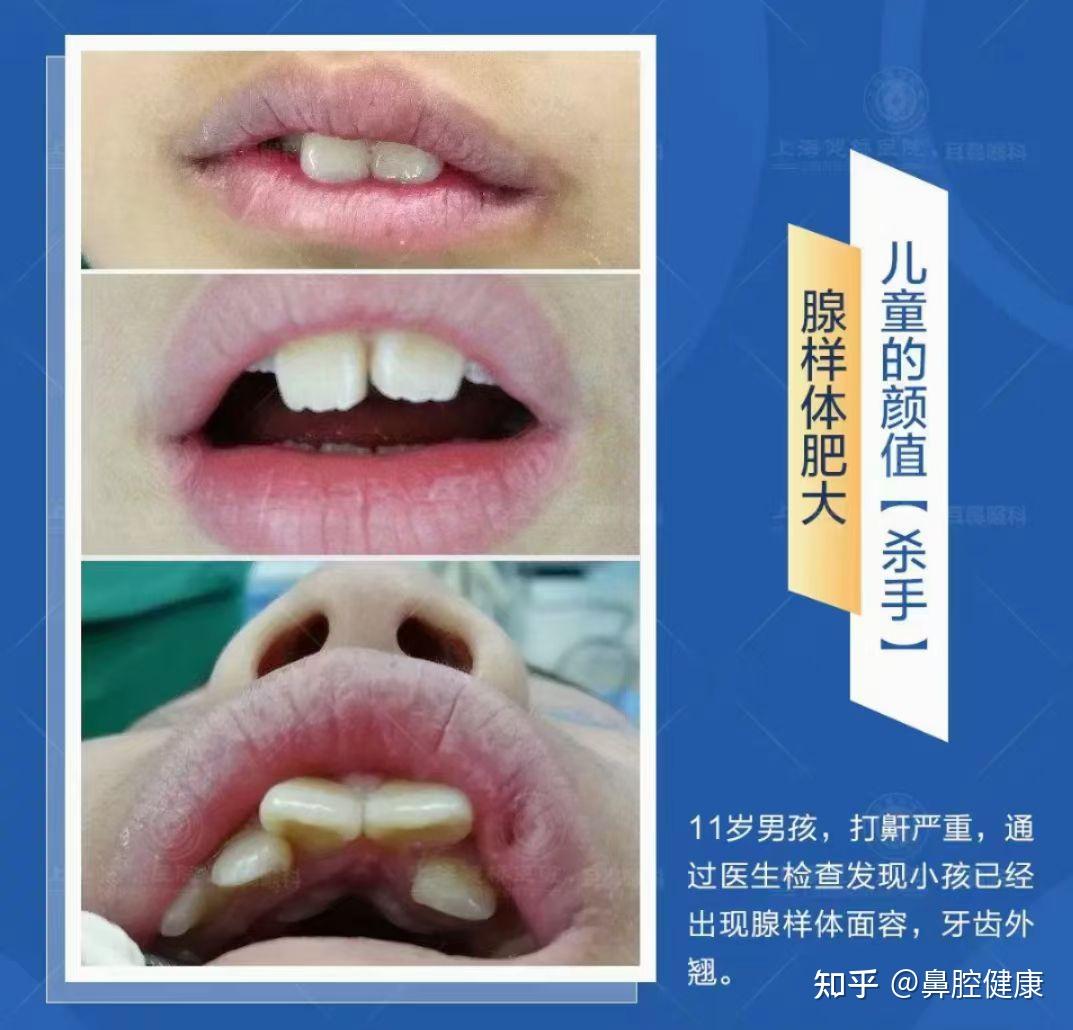 腺样体肥大的病因及危害