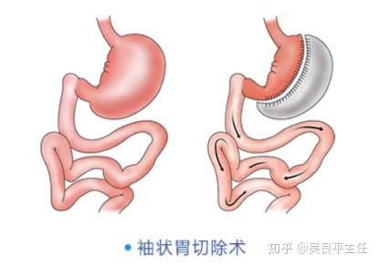 ​“胃切除了”减肥手术大名为腹腔镜下袖状胃