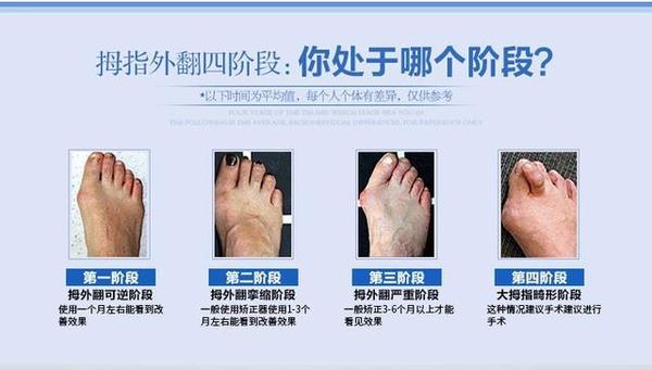 拇外翻是什么？有什么危害，大脚骨的最佳治疗方法是什么？ - 知乎