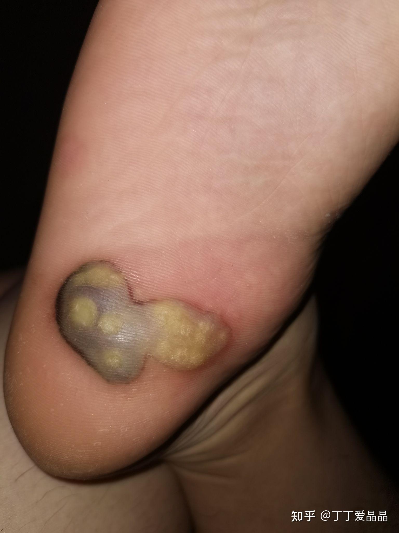 火针治疗跖疣 - 知乎