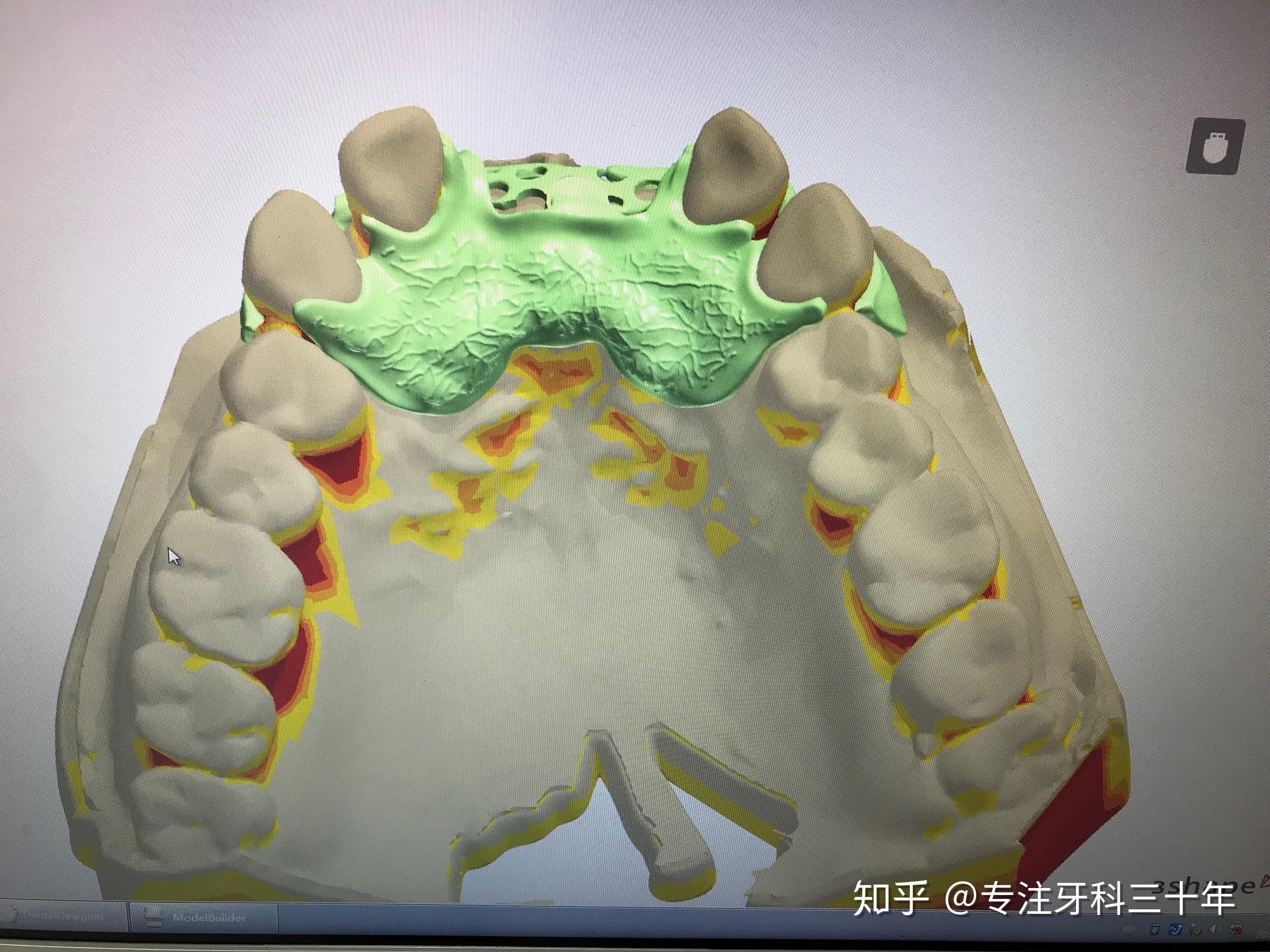 数字化局部可摘义齿案例
