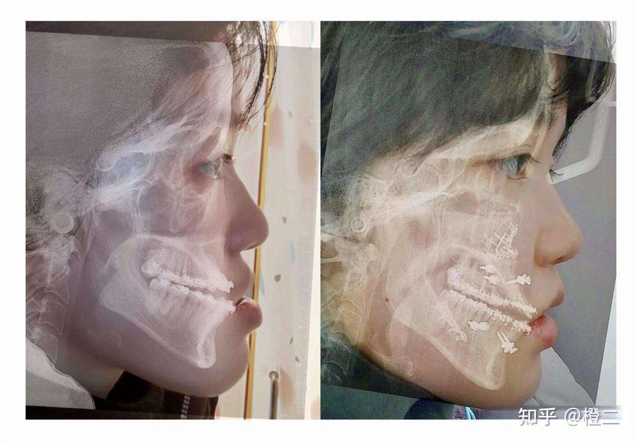 正颌手术真的有必要做吗?正颌术后能否达到标准面型?附正畸or正颌自测 - 知乎