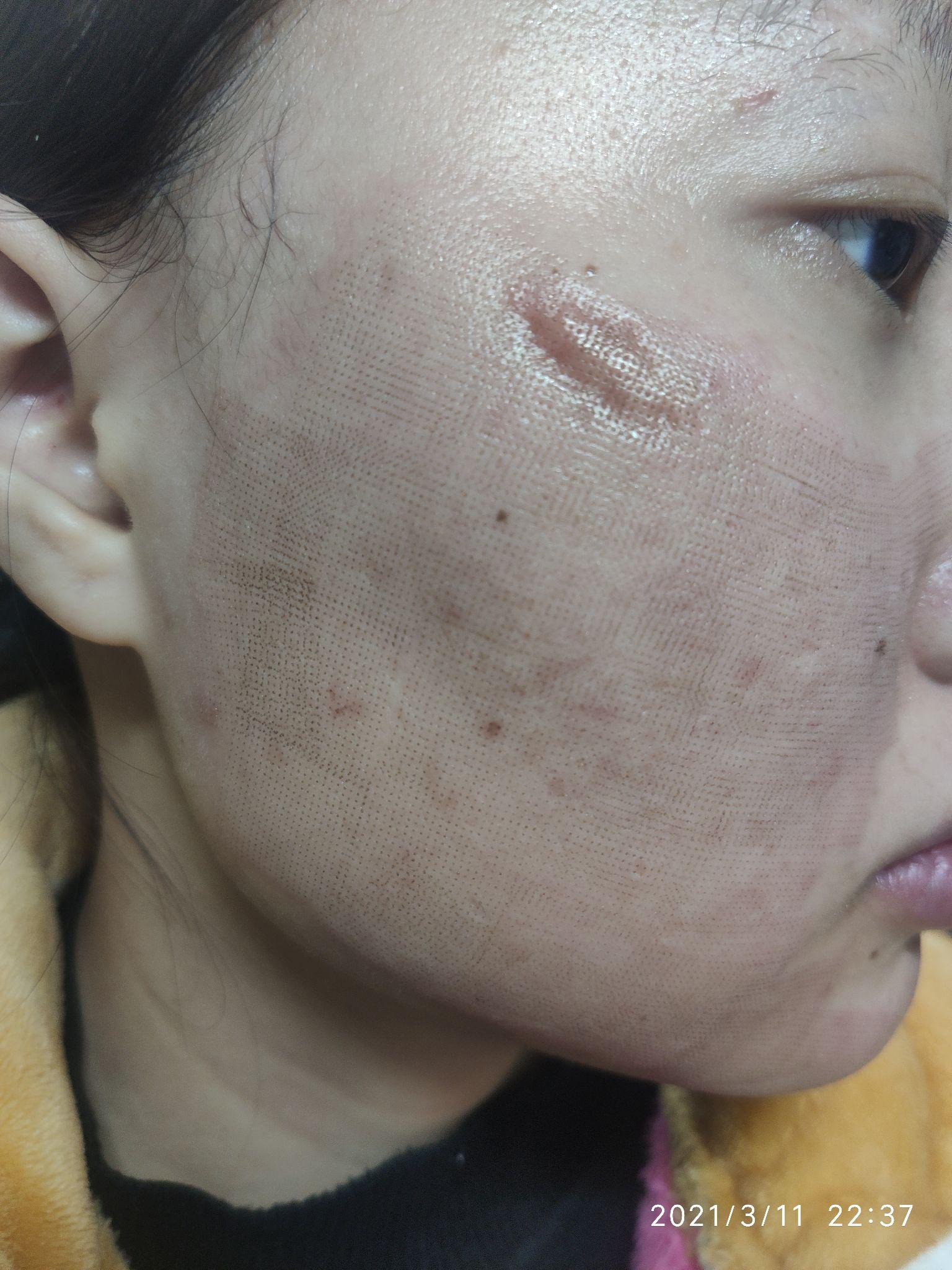 面部凹陷性疤痕修复自体脂肪填充1次3次点阵激光1次手术切缝