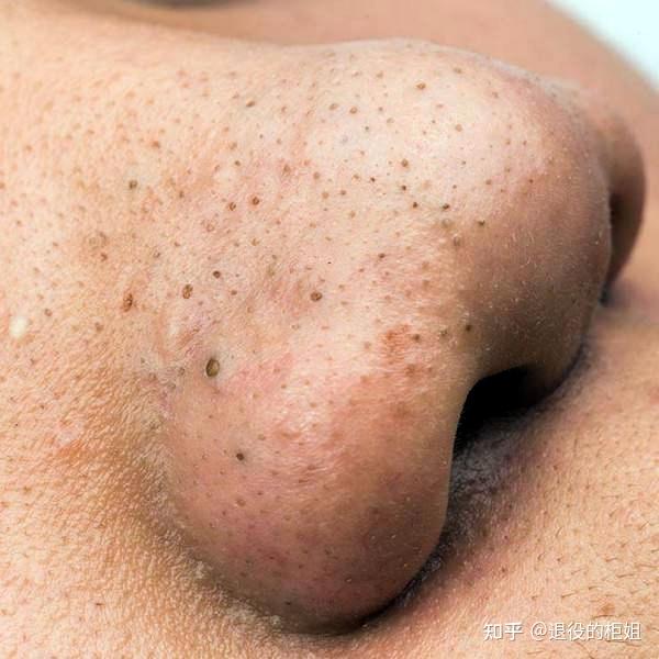 超大黑头怎么办