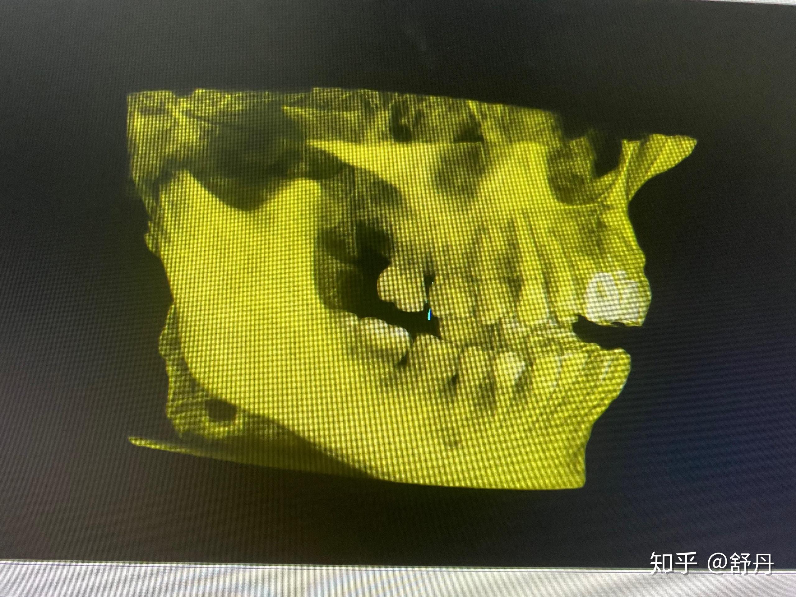 上颚骨口腔囊肿我的门牙改怎么处置啊求意见