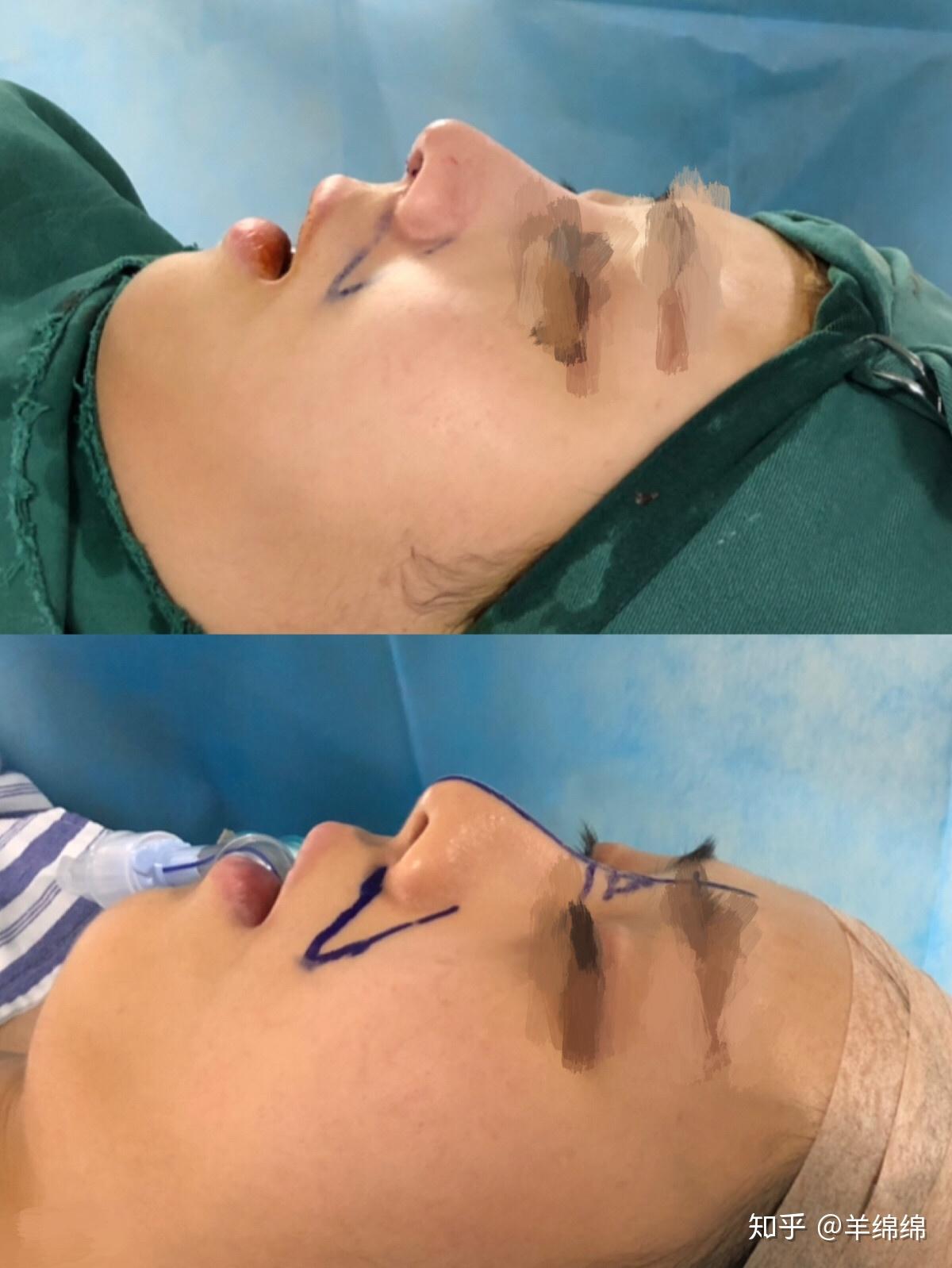 有的是需要做隆鼻就可以解决,有的就需要垫高鼻基底,就比如binder综合