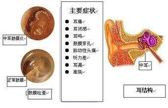 患上中耳炎的一些早期症状 知乎 患上中耳炎的一些早期症状 知乎