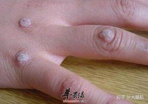 处理手指上皮肤疣的两个办法