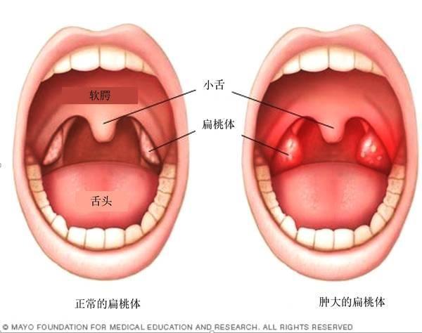 有一种口臭是扁桃体长了石头