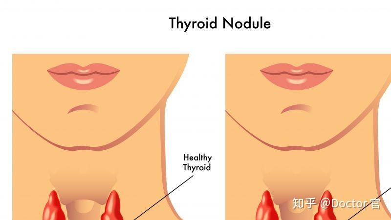 平時不痛不癢的,在偶然的體檢時才被告知長了甲狀腺結節,這其中90%的