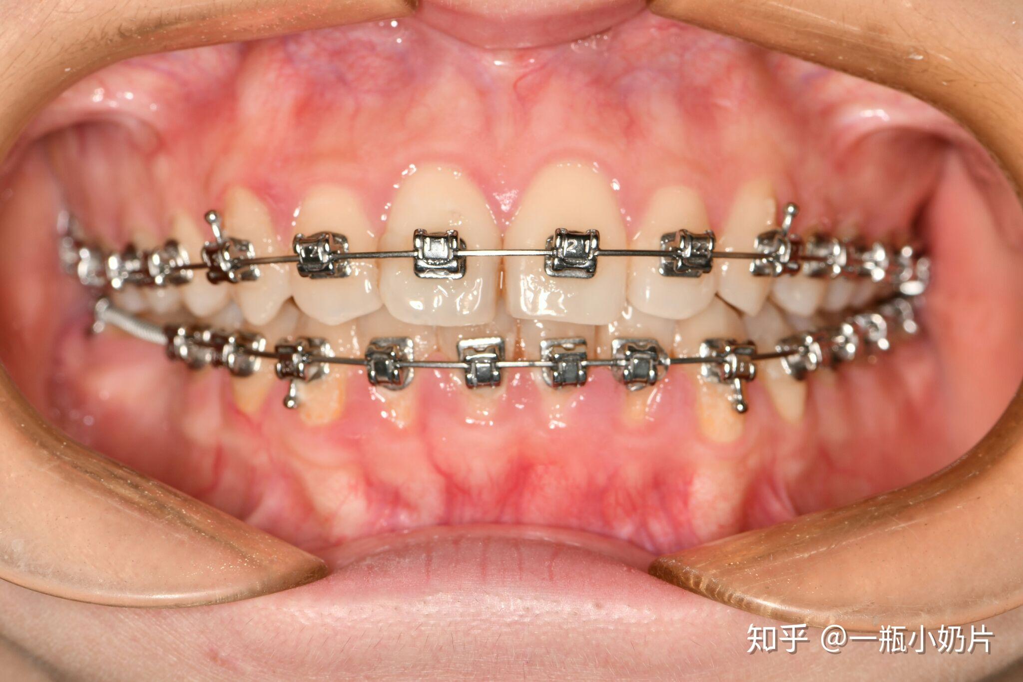 在福州牙齿矫正戴小钢牙后悔吗? - 知乎