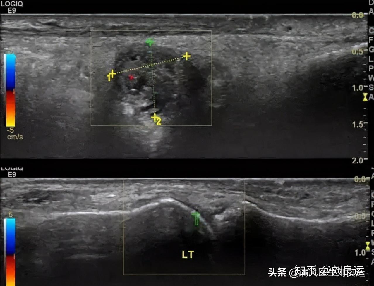 痛风可以吃花生米不尿酸降低了痛风石就溶解了