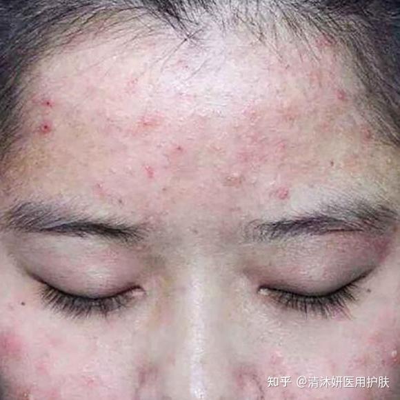 "换季式变丑"是一种什么体验?