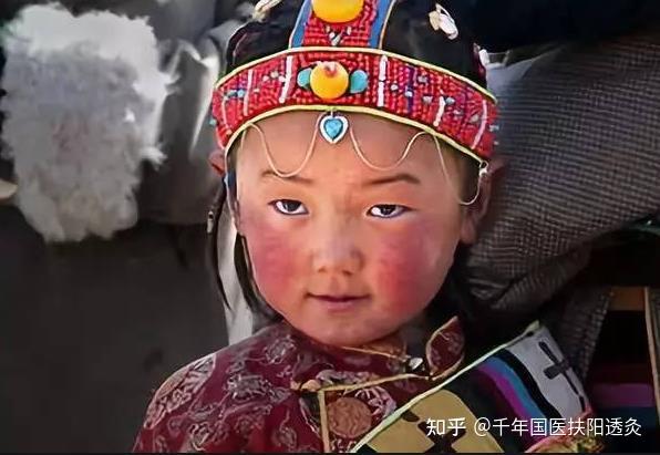 为什么到冬天脸蛋就会出现高原红