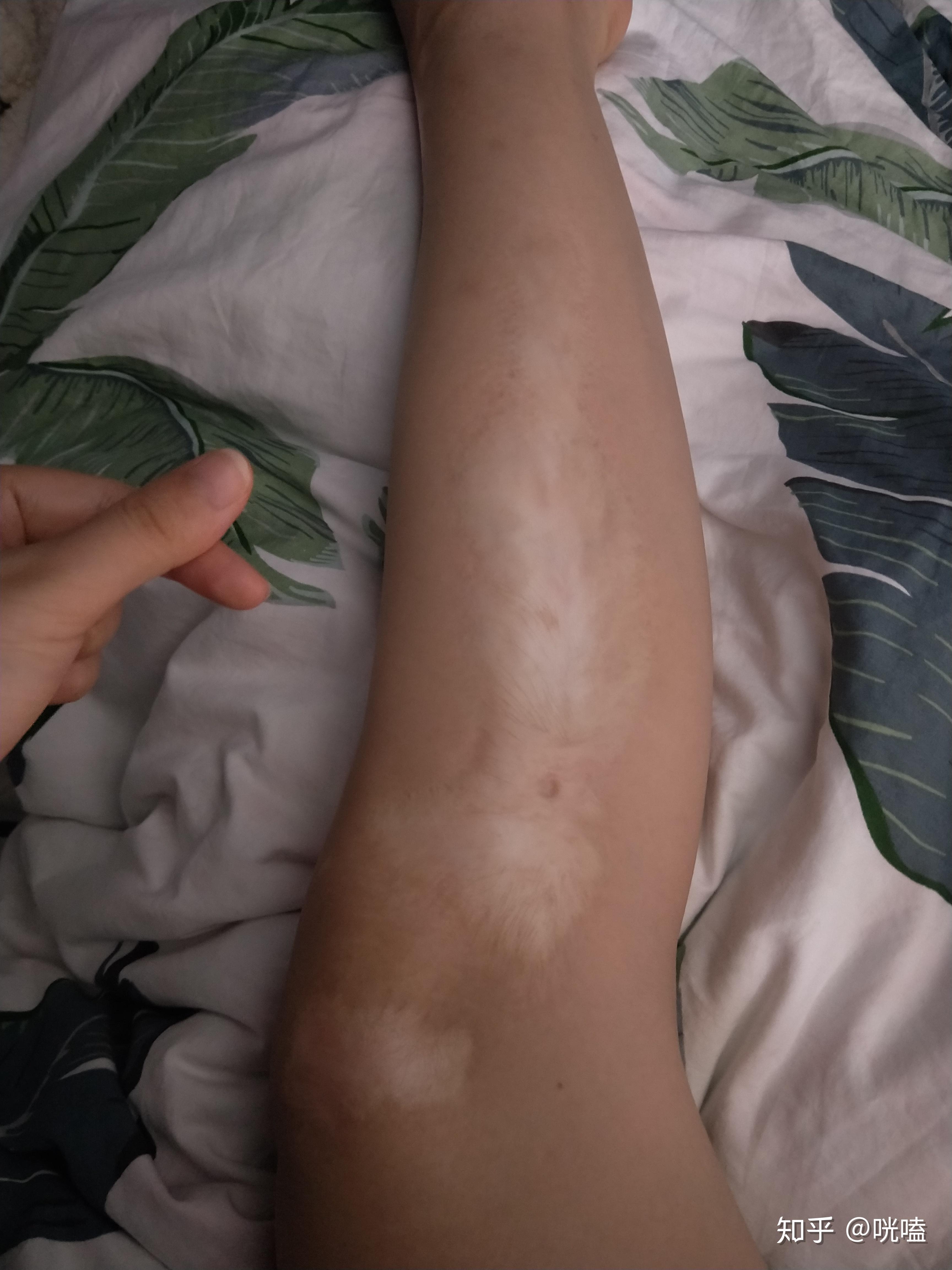 人们看到一个腿上有烫伤疤痕的女孩会怎么想呢?