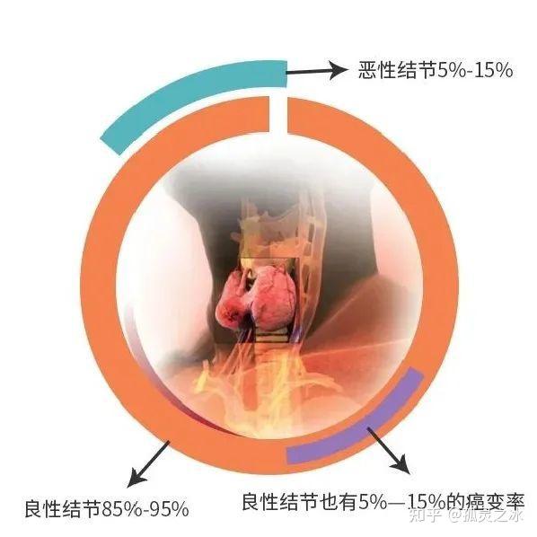 甲狀腺結節中515是惡性出現這四個症狀甲狀腺可能出事了