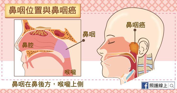 患鼻咽癌與講粵語有關關於早期鼻咽癌篩查