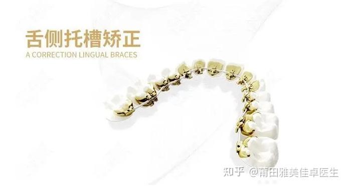 莆田牙齿矫正||舌侧矫治器的构成 - 知乎