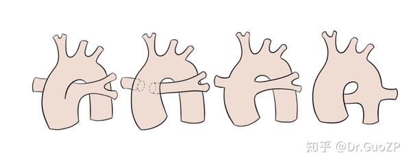 聊聊先天性心脏病——共同动脉干