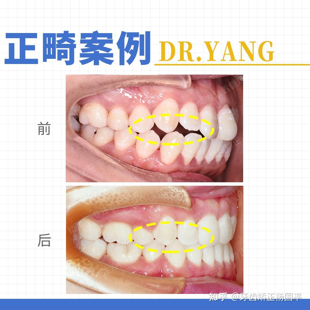 #上海牙齿矫正|面突+前牙区开颌案例⭐舌侧矫正优势! - 知乎