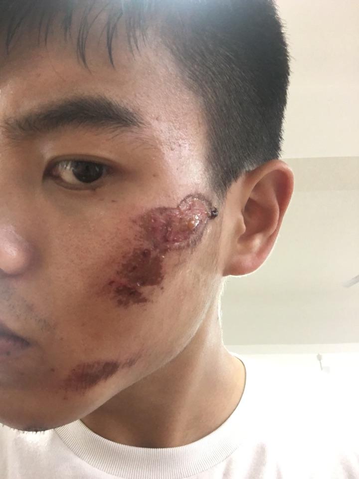 脸部擦伤结痂已经掉了。但是红黑的一片，怎样才能避免留疤？