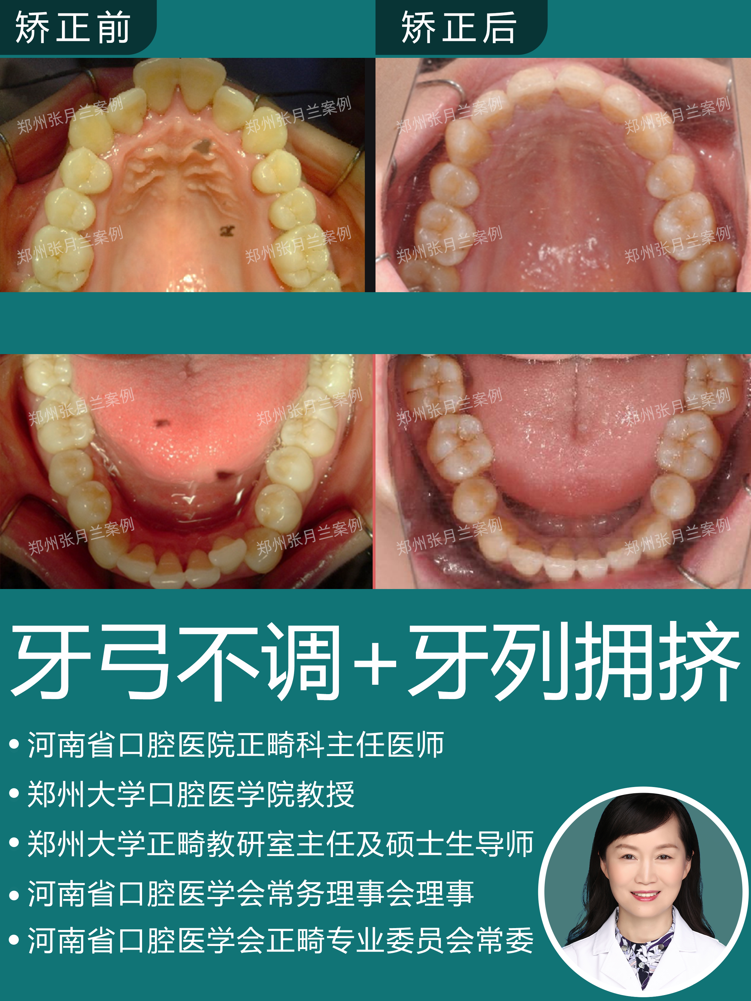 郑州牙套我为什么重视牙弓的协调美