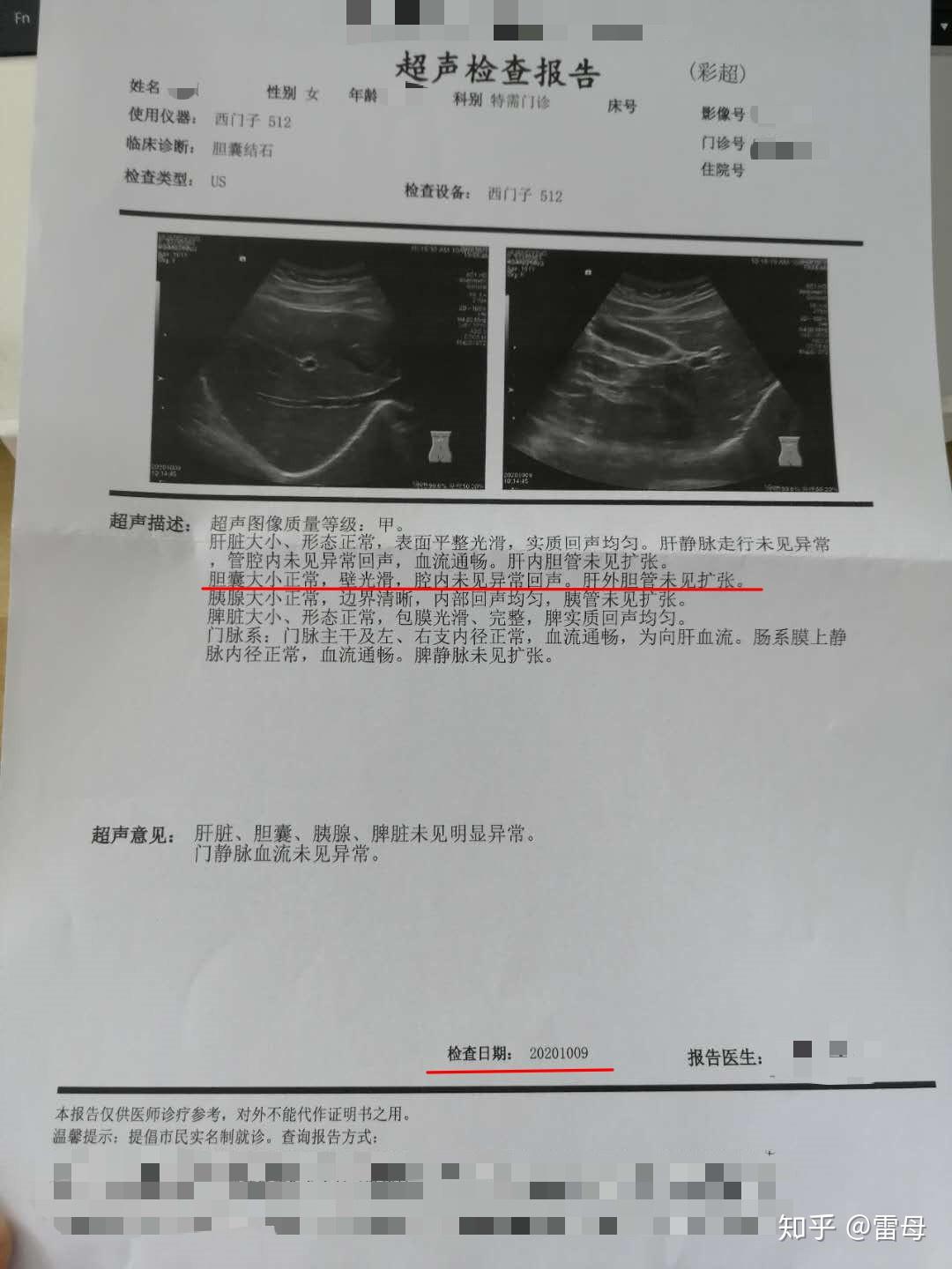 肝内胆管结石彩超报告图片