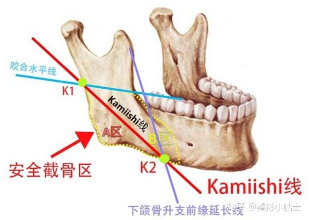 就是安全截骨线—与下颌骨升支前缘延长线与下颌骨前缘的交点k2之间的