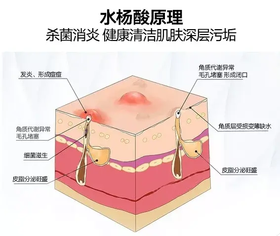 水杨酸祛痘的正确使用方法