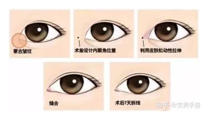 不是所有的眼睛开内眼角都会变好看！开内眼角前一定要读完这篇文章，教你理性开眼角 - 知乎