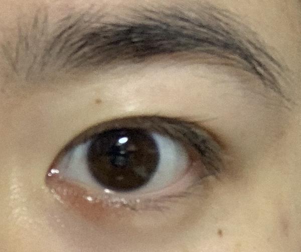 麦粒肿就下的红印子怎么去除 知乎