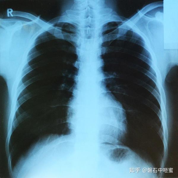 X射线 X-ray - 知乎