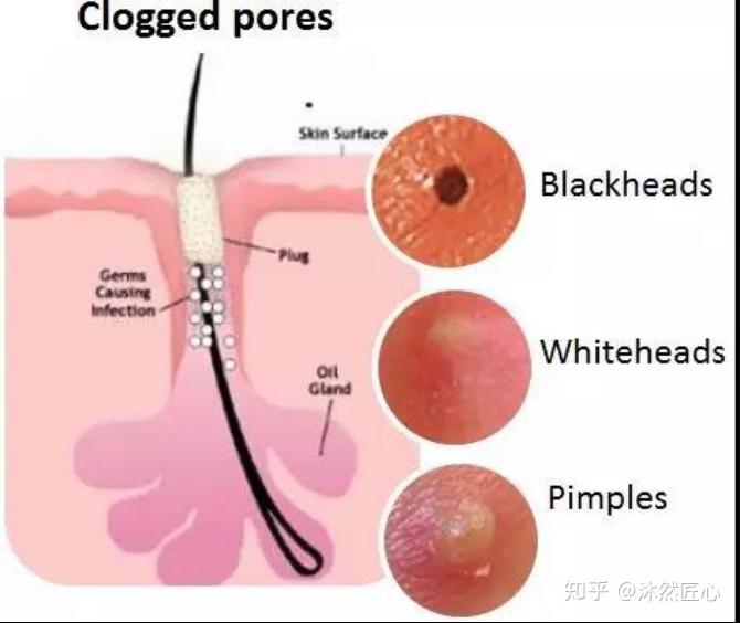 囊腫和結節(我們常說的痘痘)我們皮膚毛孔由毛囊和皮脂腺組成,其中