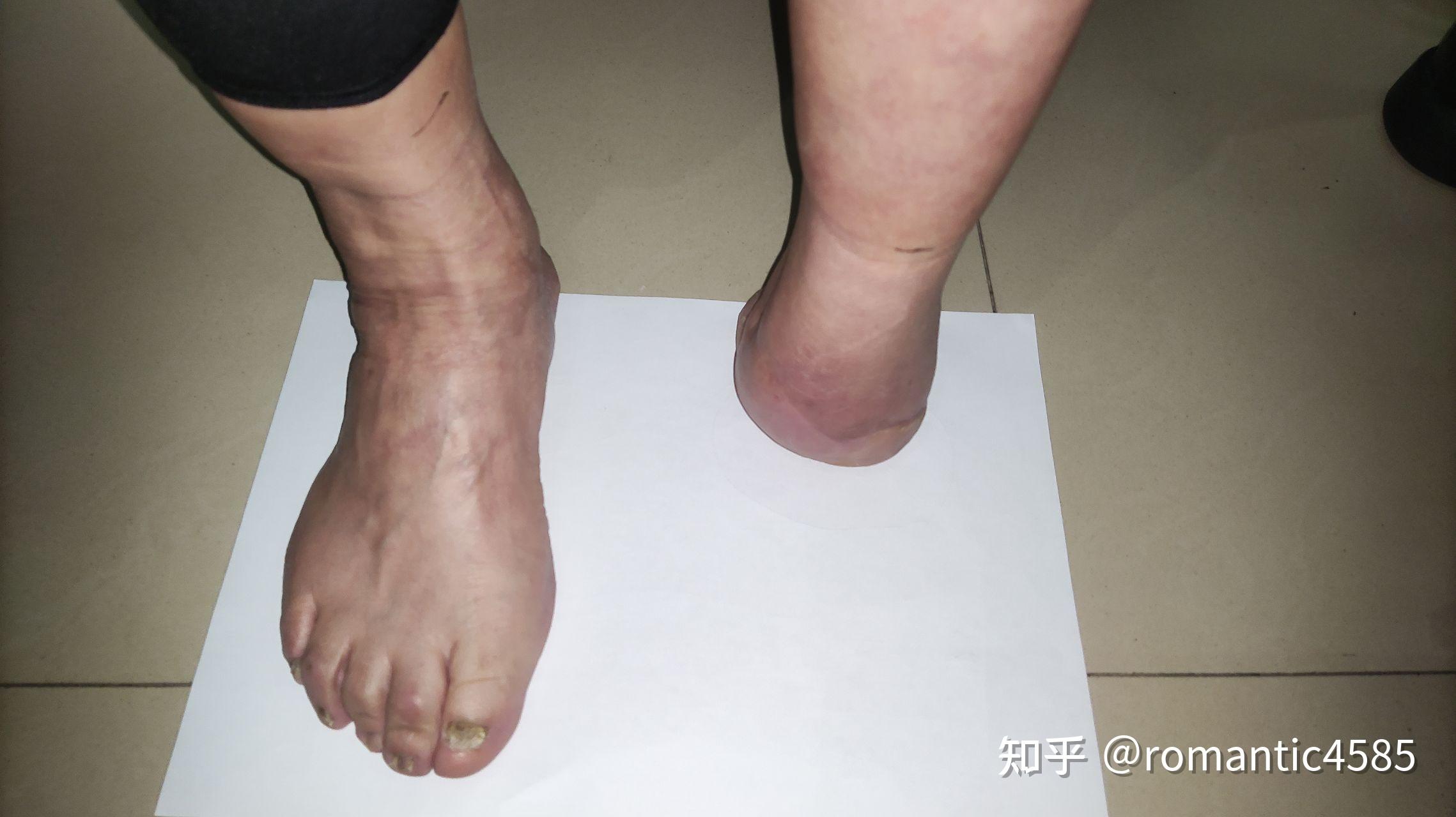 半足截肢患者如何选择假肢_优邦假肢矫形器上海有限公司_新浪博客
