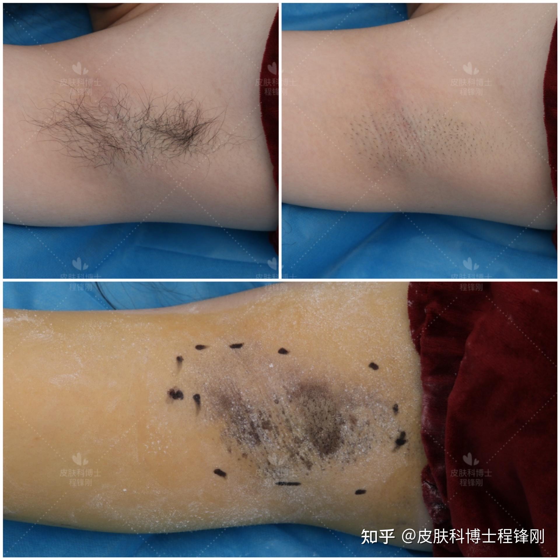 皮肤科博士程锋刚:狐臭腋臭多汗|患者问题汇总(长期更新)3 赞同 · 0