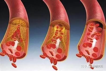 为什么血管会形成血栓?该怎么办? - 知乎