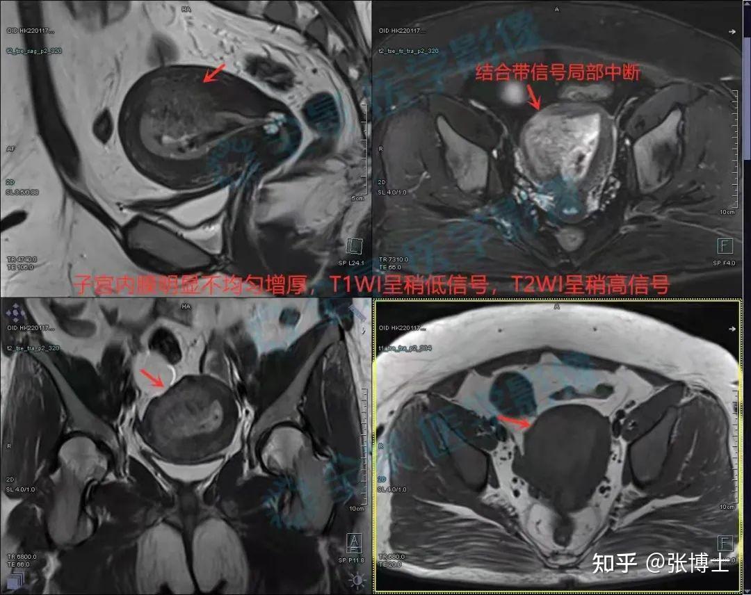 年纪轻轻怎么会子宫内膜癌